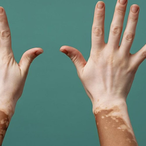 PSORIASIS Y VITILIGO